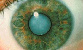 Cataracts - Eye Disorders