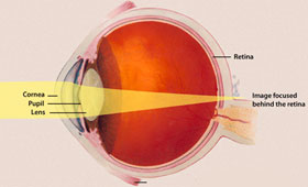 Hyperopia - Eye Disorders