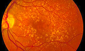 Macular Degeneration - Eye Disorders