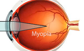 Myopia - Eye Disorders