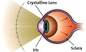 Presbyopia - Eye Disorders